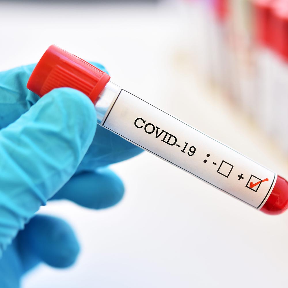 COVID-19-ce este testul la anticorpi, când se efectuează și ce informații ne oferă.