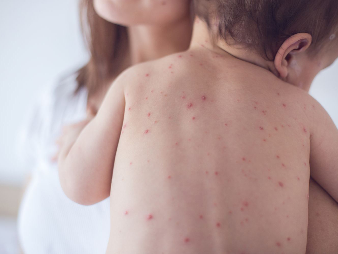 Rujeola este considerată o infecție extrem de contagioasă