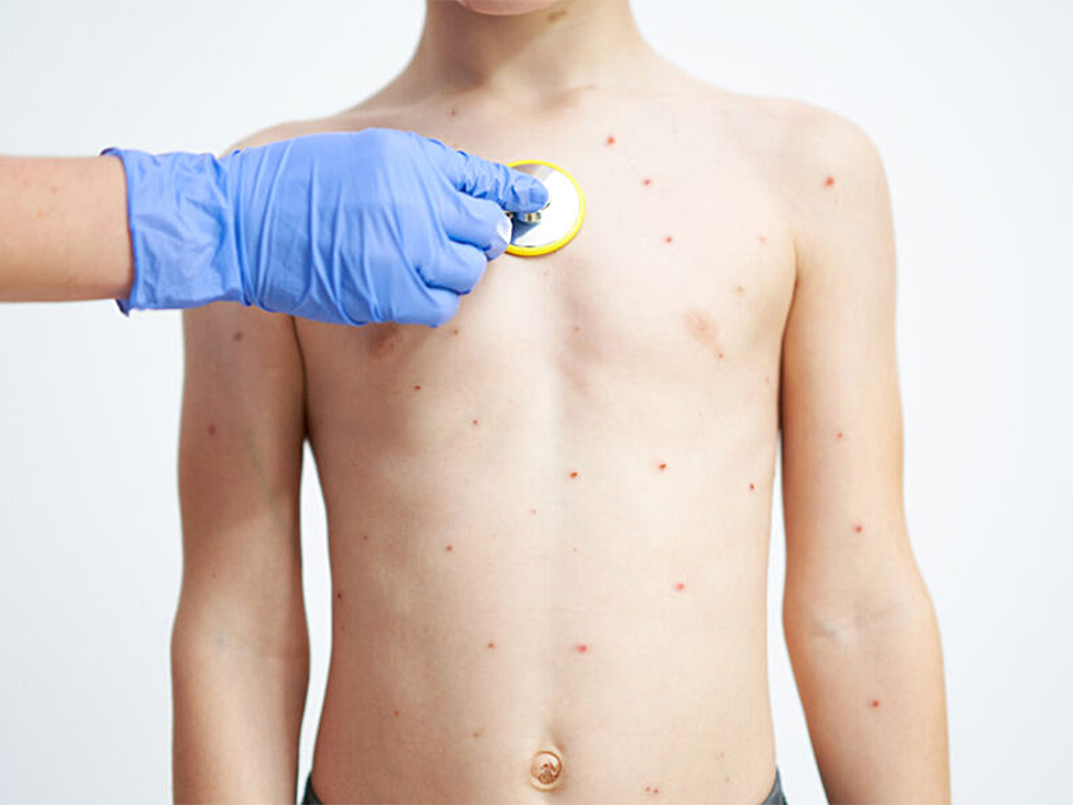 Rujeola este considerată o infecție extrem de contagioasă