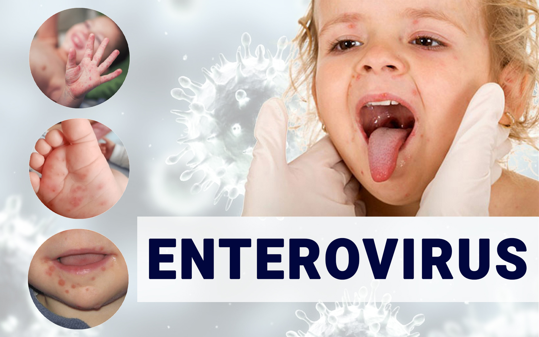 ATENȚIE la INFECȚIA ENTEROVIRALĂ